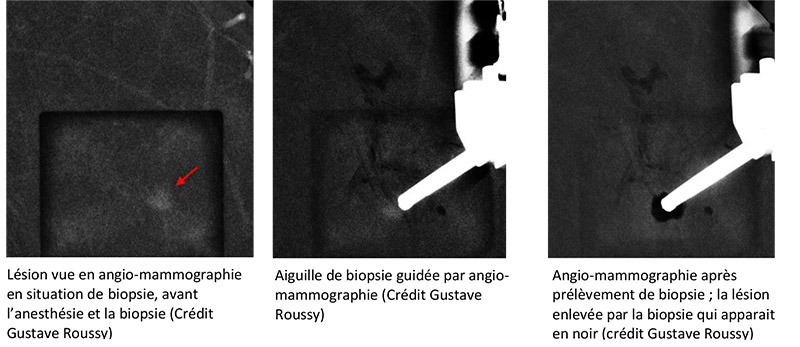 Une Biopsie Du Sein Guidée Par Angiomammographie Une Première